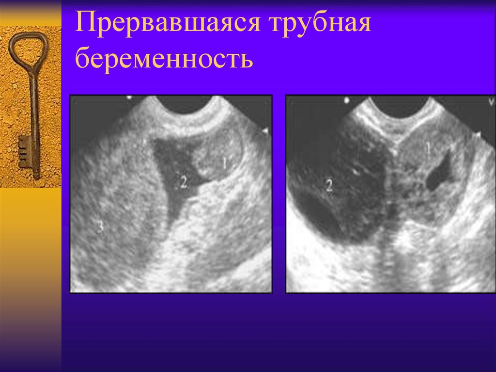 Типы внематочной беременности. Внематочная Трубная беременность УЗИ. Внематочная Трубная беременность. Трубная внематочная беременность трубный аборт. Разрыв маточной трубы на УЗИ.