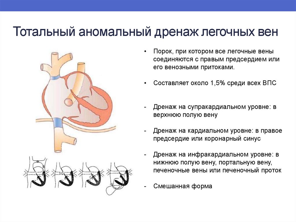 Тотально это. Аномальный дренаж легочных вен клинические рекомендации. Частичный аномальный дренаж легочных вен (ЧАДЛВ). Инфракардиальный аномальный дренаж легочных вен. Частичный аномальный дренаж легочных вен у новорожденных ЭХОКГ.