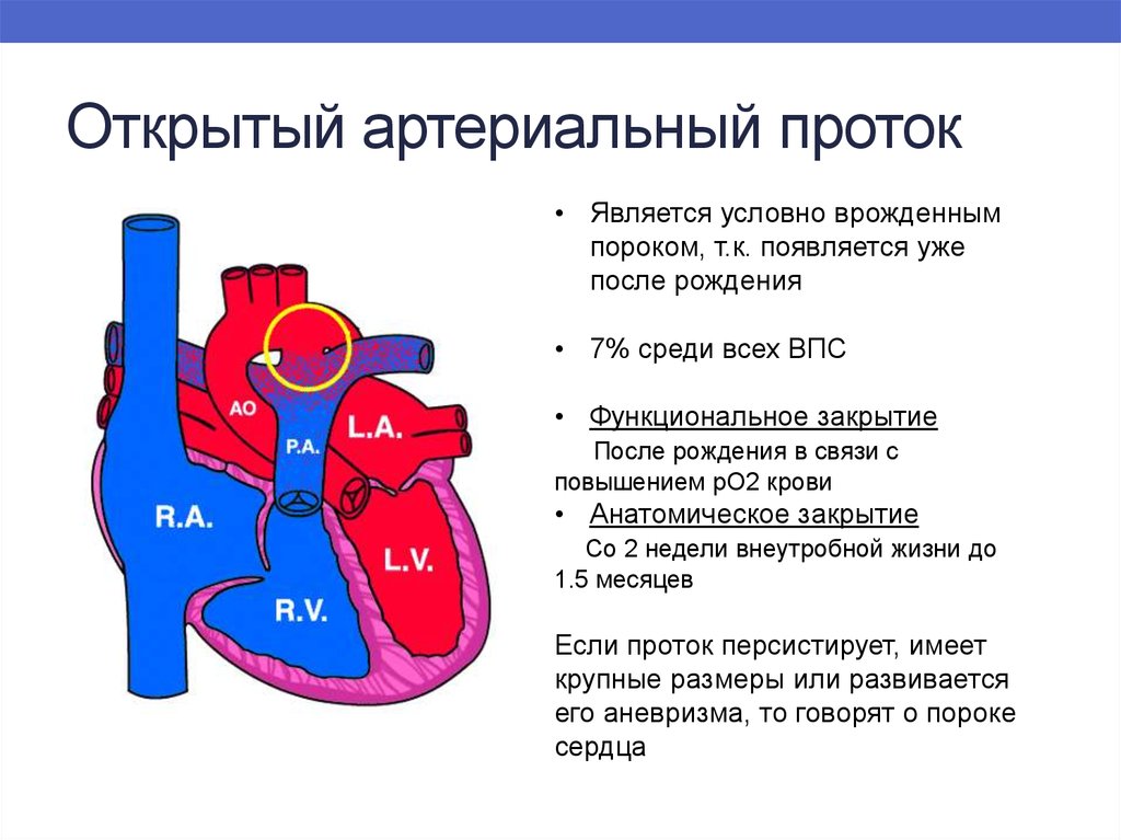 Оап у новорожденных. Пороки сердца боталлов проток. Врожденный порок сердца открытый артериальный проток. ВПС открытый артериальный проток у детей. Открытый артериальный проток при ВПС.