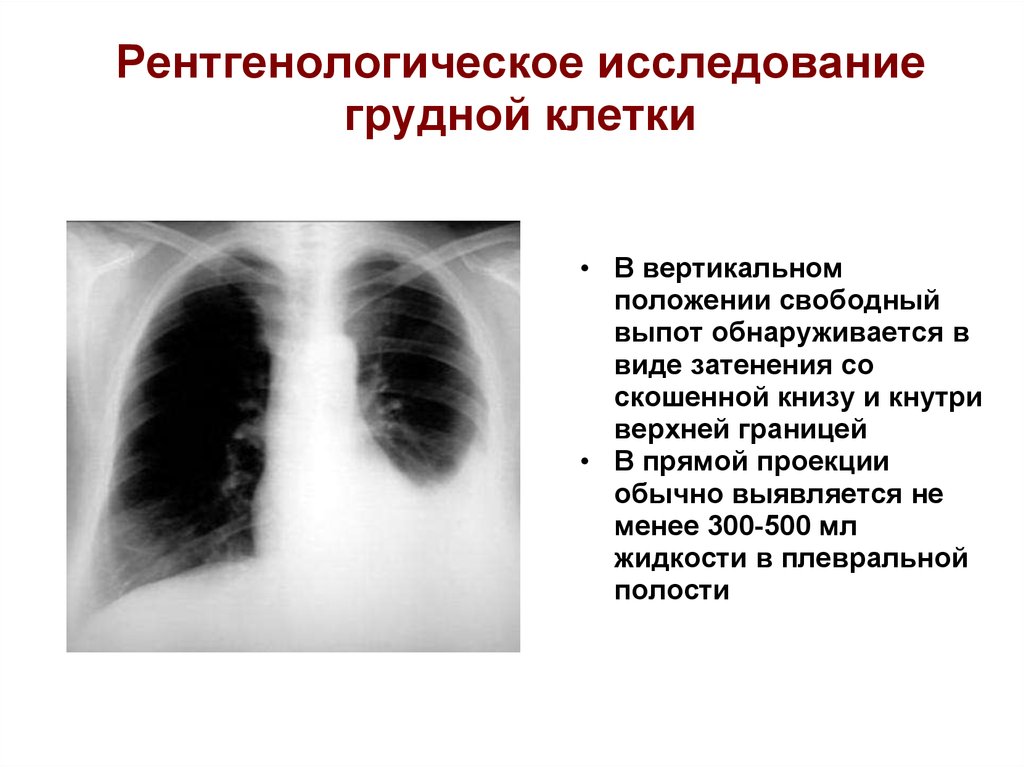 Почему на рентгеновском снимке изображение газа в плевральной полости черное