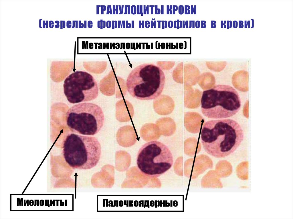 Гранулоциты это. Незрелые формы нейтрофилов. Палочкоядерных нейтрофилов в периферической крови. Незрелые гранулоциты. Незрелые гранулоциты в крови.