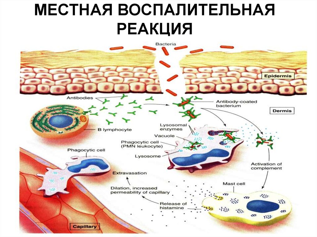 Воспалительный процесс в организме. Механизм воспалительной реакции физиология. Схема воспалительной реакции. Схема воспалительного процесса. Механизм развития воспалительной реакции.