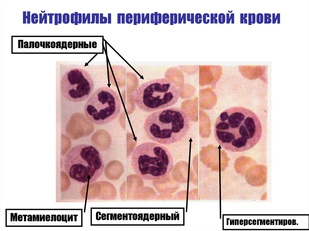 Палочкоядерные. Палочкоядерные нейтрофилы. Нейтрофилы метамиелоциты. Сегментоядерные нейтрофилы под микроскопом. Метамиелоциты в периферической крови.