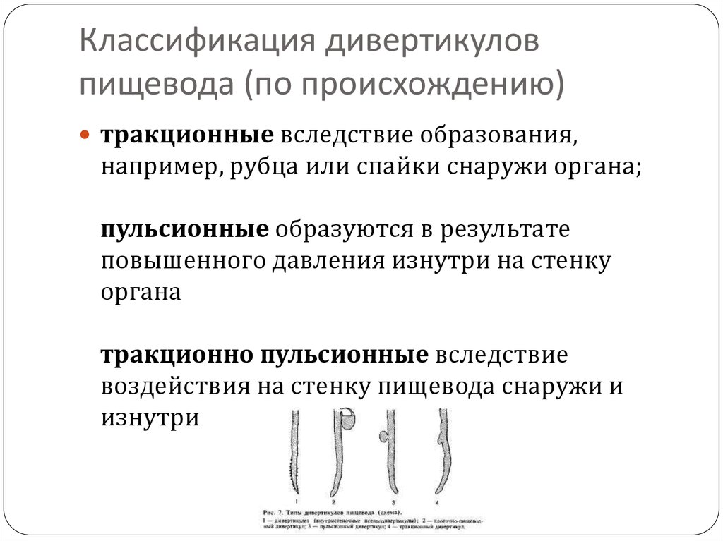 Презентация дивертикул пищевода