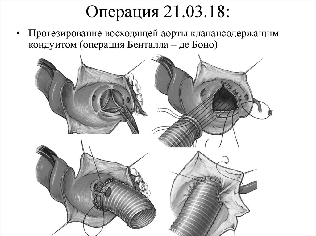 Аневризма восходящей аорты операция