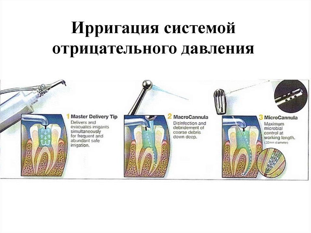 Ирригация корневых каналов презентация