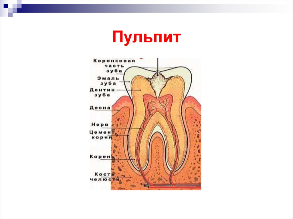 Хронические формы пульпита презентация