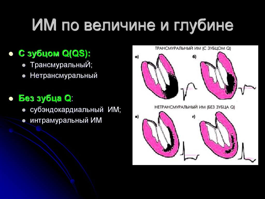 Трансмуральный инфаркт миокарда. Трансмуральный и нетрансмуральный. Трансмуральный и нетрансмуральный инфаркт. Нетрансмуральный инфаркт миокарда. Трансмуральный и интрамуральный.