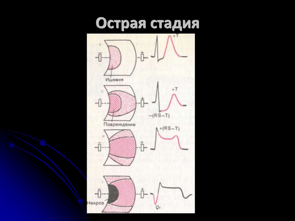 Крупноочаговый и мелкоочаговый инфаркт миокарда. Острый трансмуральный инфаркт миокарда. Острая стадия. Трансмуральный инфаркт миокарда на ЭКГ.