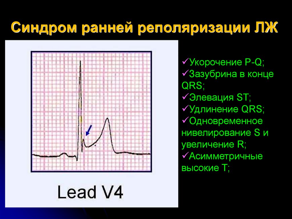 Ранняя реполяризация желудочков. Феномен ранней реполяризации желудочков. Синдром ранней реполяризации на ЭКГ. Синдром ранней реполяризации желудочков на ЭКГ. Ранняя реполяризация желудочков на ЭКГ.