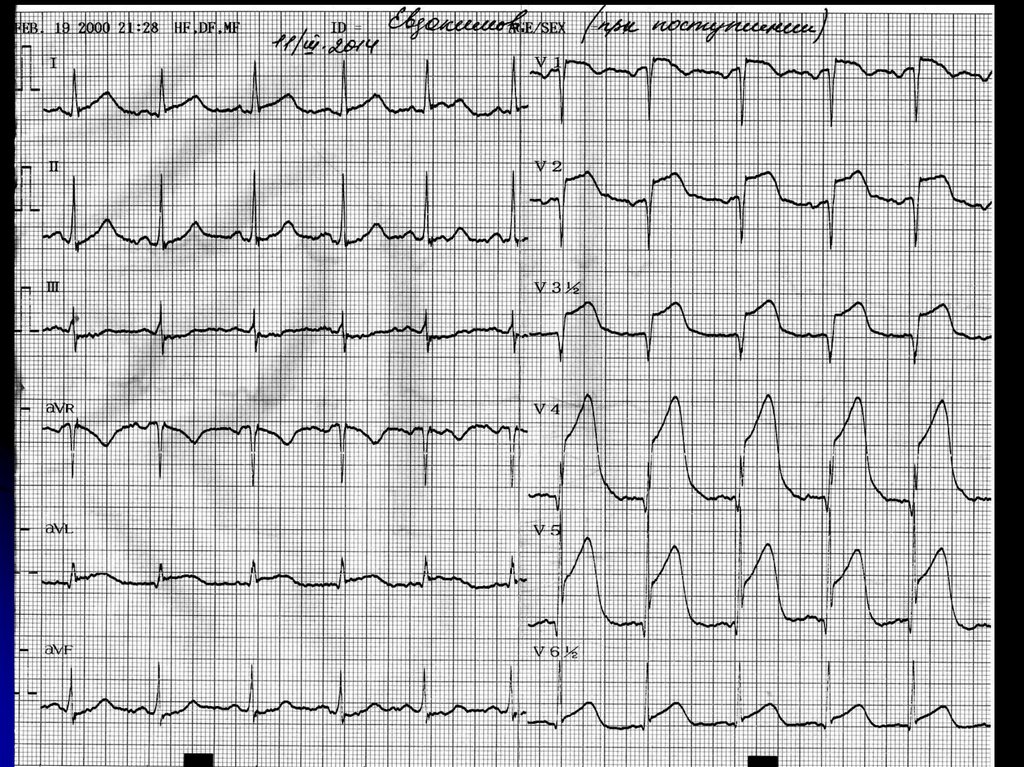 Инфаркт на экг. Нижнебоковой инфаркт ЭКГ. Инфаркт с подъемом сегмента St передней стенки ЭКГ. Инфаркт переднеперегородочной области на ЭКГ. ЭКГ переднего инфаркта с подъемом St.