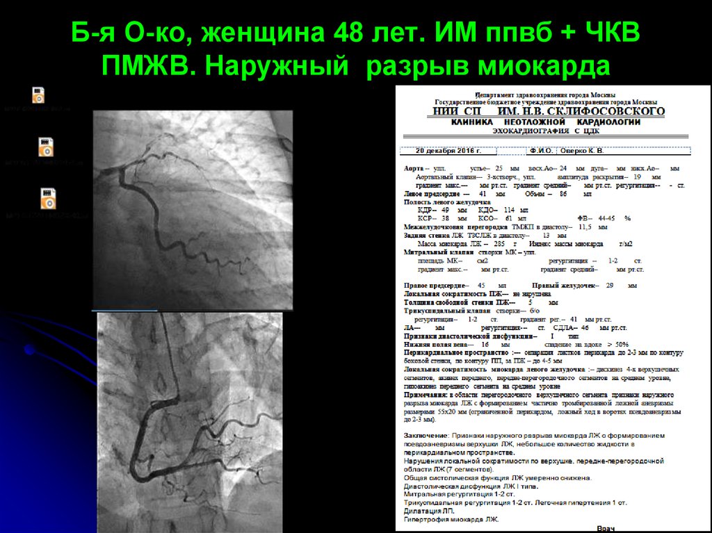 Разрыв миокарда. ЧКВ В кардиологии. ЧКВ при инфаркте миокарда.