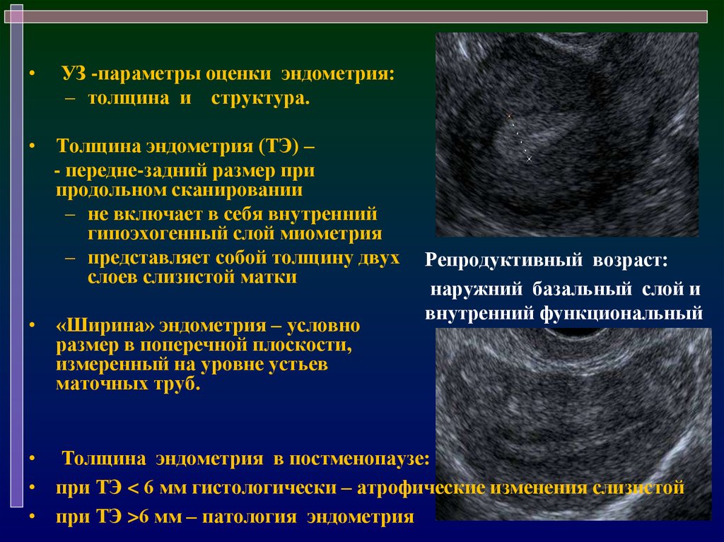Эндометрий д. Ультразвуковые критерии гиперплазии эндометрия. Железистая гиперплазия эндометрия УЗИ. Гиперплазия эндометрия по УЗИ. Гиперпластические процессы эндометрия УЗИ.
