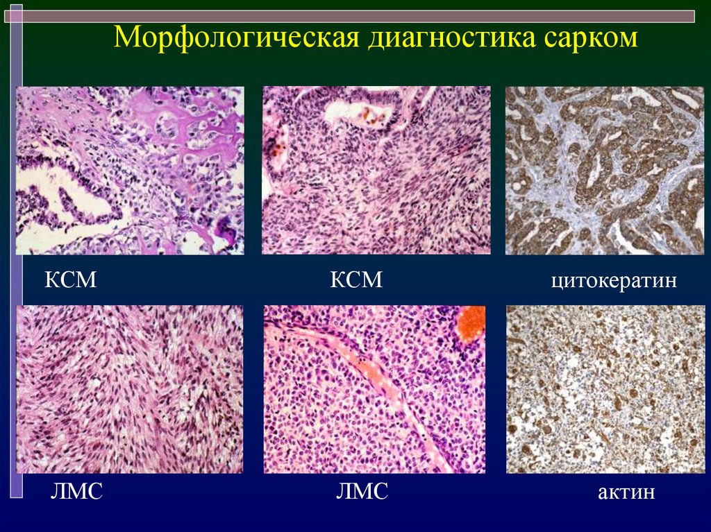 Виды сарком. Морфологическая классификация сарком. Саркома матки классификация. Морфологический диагноз. Классификация сарком тела матки.