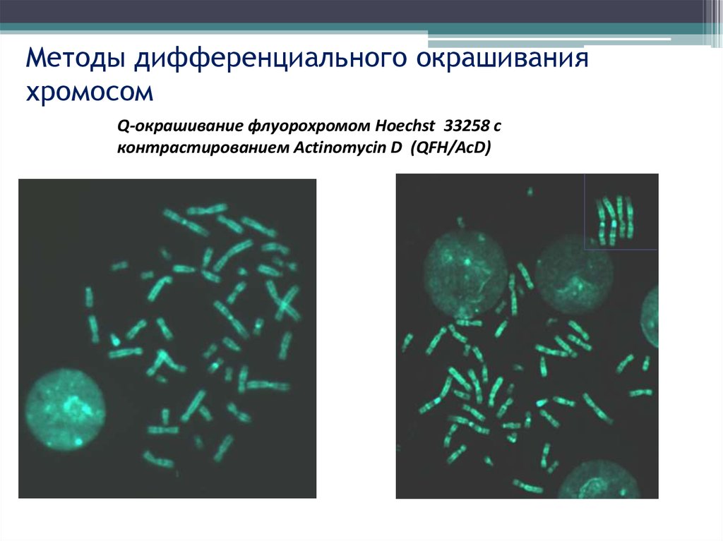 Метод хромосом. Методы дифференциальной окраски хромосом. Метод дифференциального окрашивания хромосом. Методы дифференциального окрашивания хромосом. Бэндинг.. Дифференциальная g-окраска хромосом.