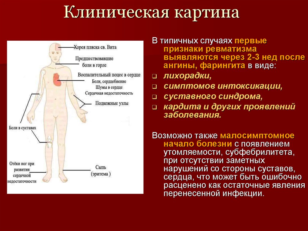 Острые лихорадки клиническая картина