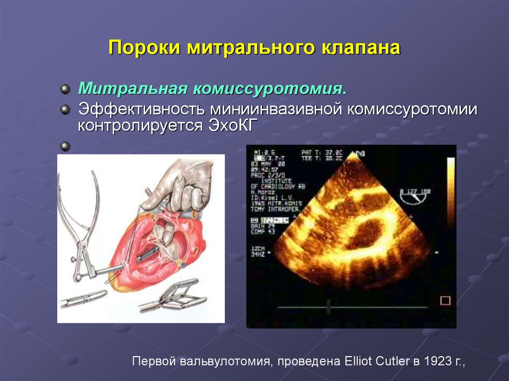 Ревматический порок митрального клапана