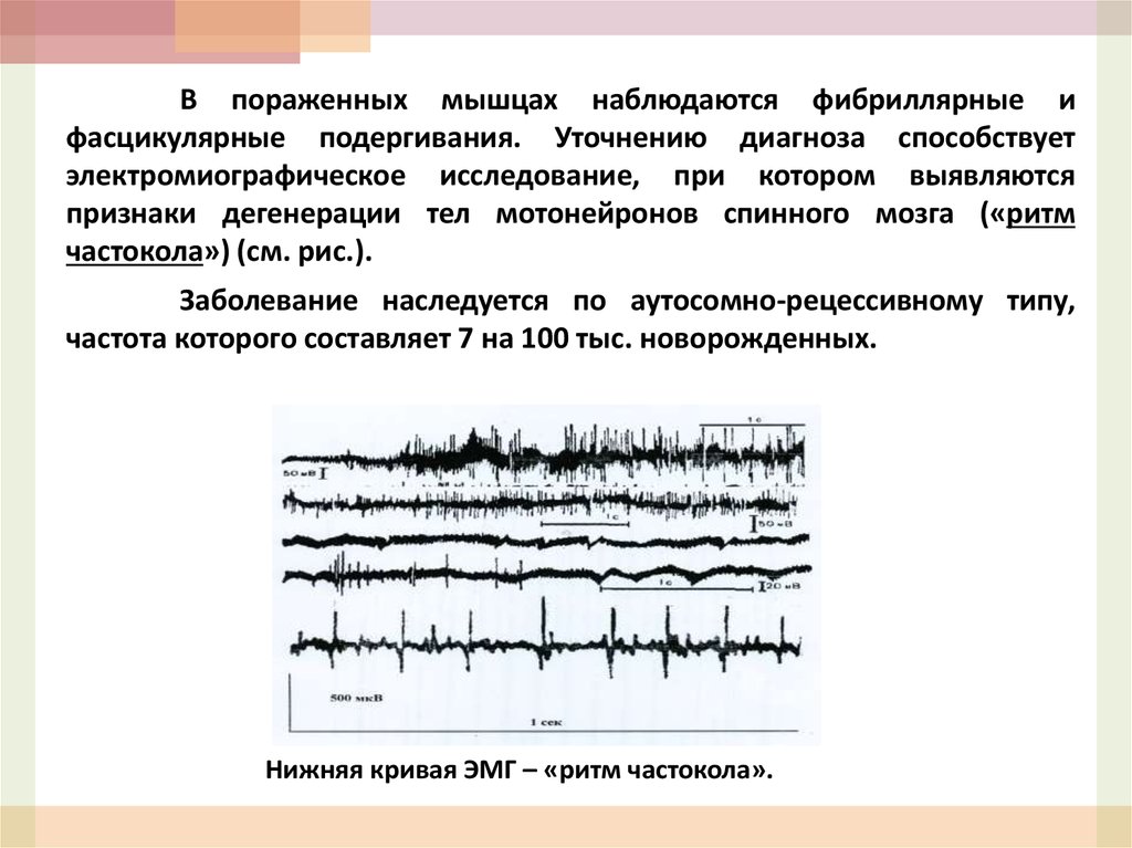 Фасцикулярные подергивания. Фибриллярные и фасцикулярные подергивания. Фибриллярные подергивания. Фибриллярные и фасцикулярные подергивания мышц.