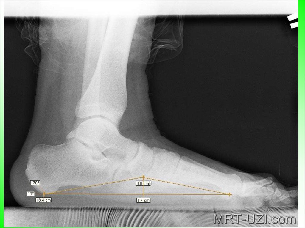 Углы стопы. Рентген стоп плоскостопие 3 степени. Продольное плоскостопие 3 степени рентген. Рентген стопы с плоскостопием 3 степени. Снимок плоскостопия 2 степени.