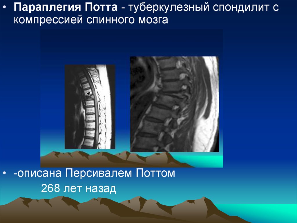 Параплегия. Спондилит презентация. Спондилит с компрессией.