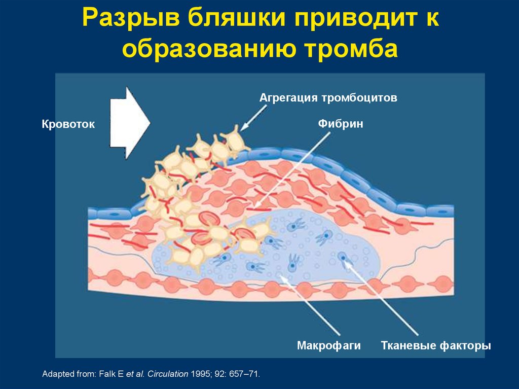 Тромб и бляшка разница. Разрыв атеросклеротической бляшки патогенез. Разрыв капсулы атеросклеротической бляшки. Разрыв холестериновой бляшки. Причины отрыва атеросклеротической бляшки.