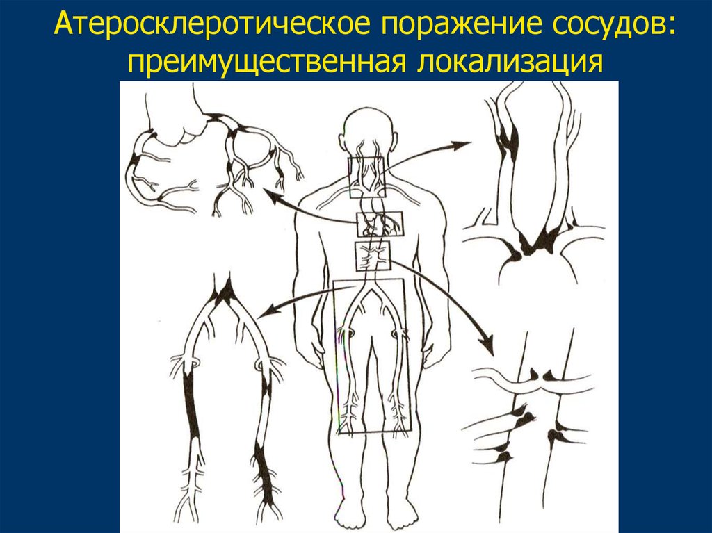 Атеросклеротическое поражение. Основные локализации атеросклеротического поражения сосудов. Основная локализация атеросклеротического поражения сосудов. Преимущественная локализация атеросклеротического процесса. Локализация атеросклеротического порока.