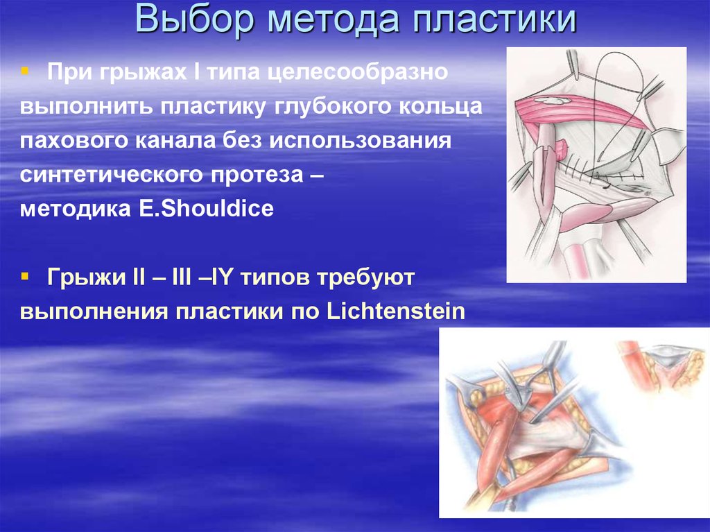 Способы пластики грыж