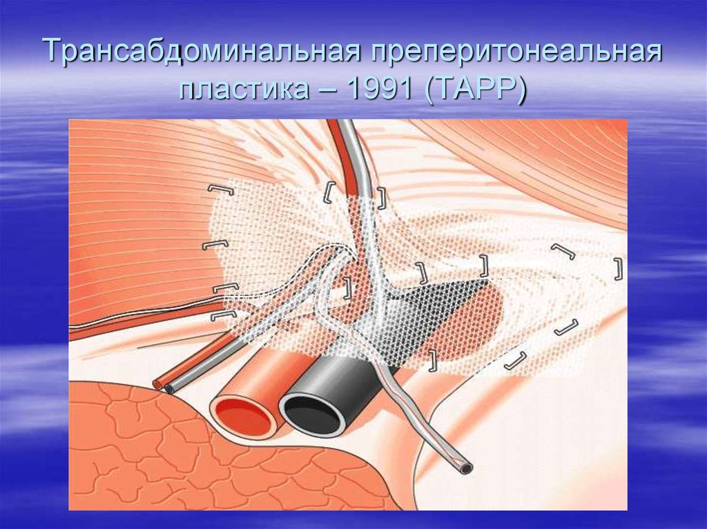 Операция расшифровка. Лапароскопическая герниопластика Тарр. Трансабдоминальная преперитонеальная герниопластика (Tapp). Лапароскопическая трансабдоминальная предбрюшинная герниопластика.