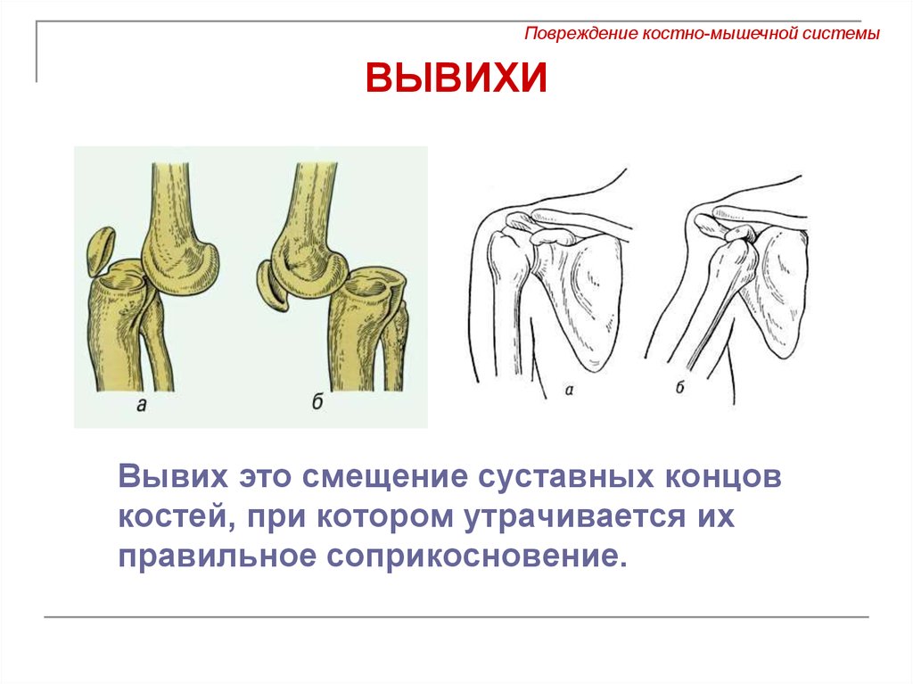 Полное расхождение суставных концов костей. Открытые и закрытые вывихи. Откирти вывих.