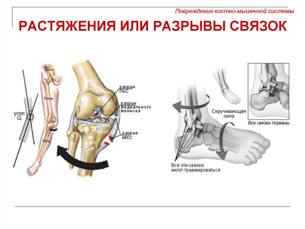 Травмы мышц. Схема обследования костно мышечной системы. Травмы костно мышечной системы. Растяжения и разрыв связочного аппарата,. Травмы опорно-двигательного аппарата схема.