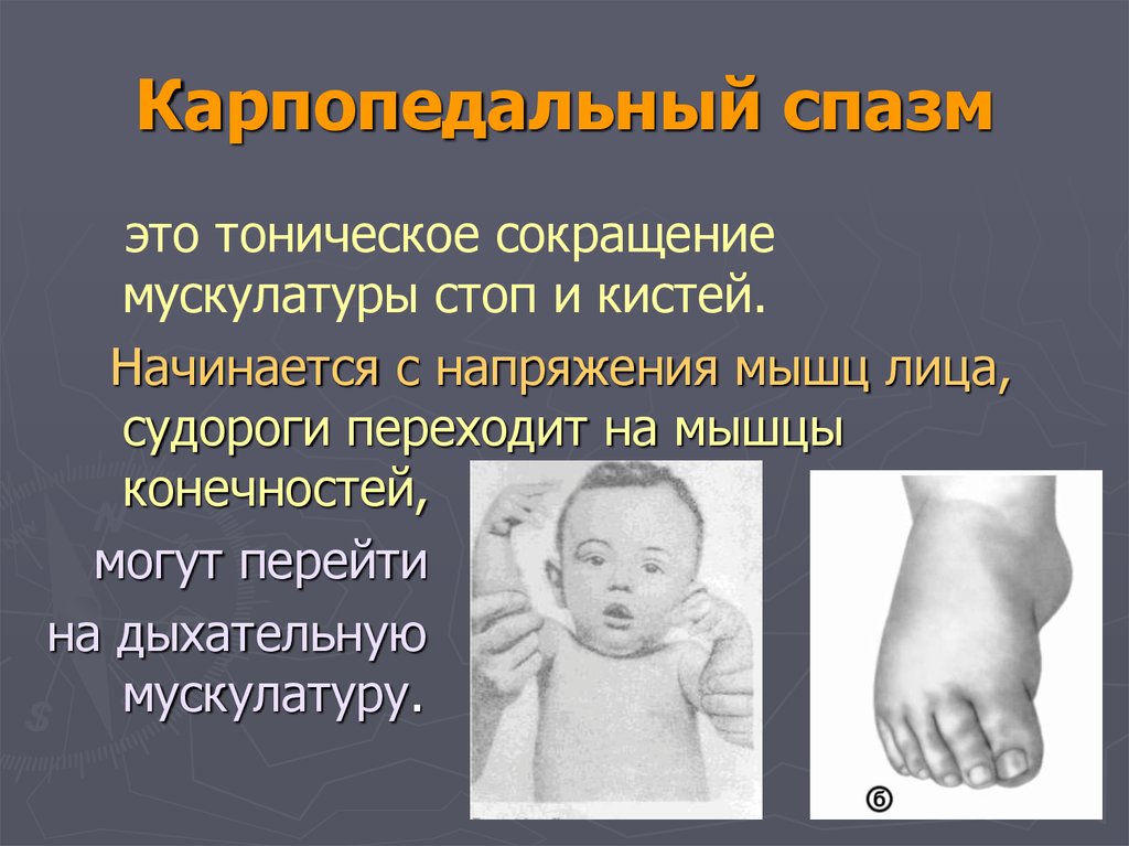 Спазм это. Карпопедальный синдром. Карпопедальный спазм у детей. Карпопедальный спазм характерен для.