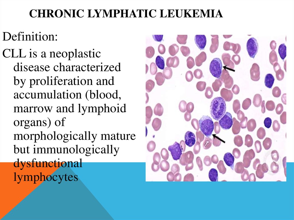 Chronic Lymphocytic Leukemia Online Presentation