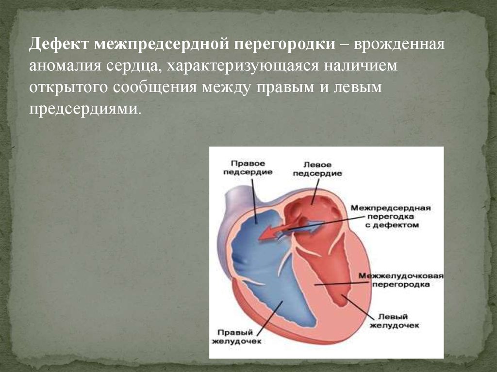 Дефекты перегородок. Шунт межпредсердной перегородки. Лабильная межпредсердная перегородка. Дефект межпредсердной перегородки сердца. ДМПП сердца у детей операция.