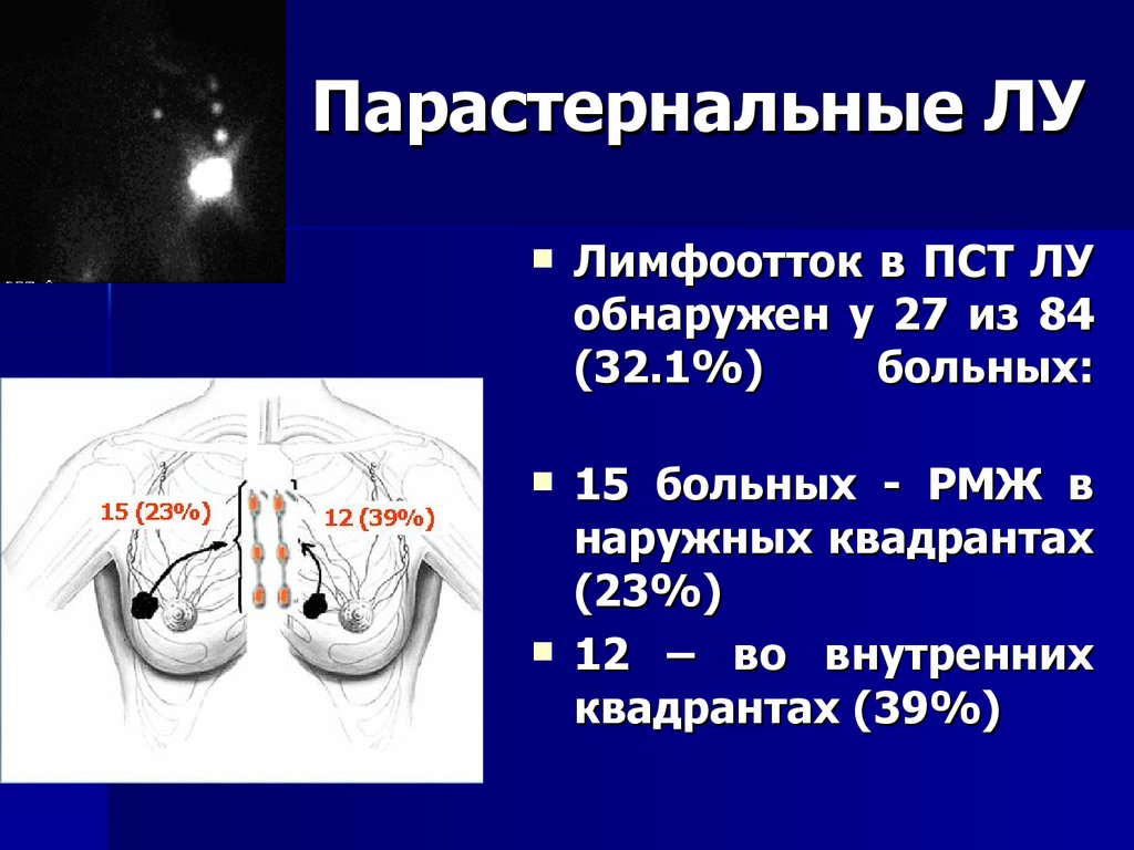 Парастернальная линия это