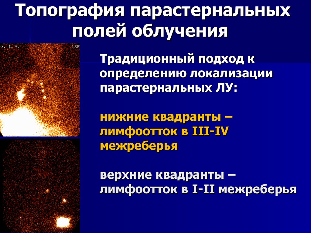 Традиционный подход к определению локализации парастернальных ЛУ: нижние квадранты – лимфоотток в III-IV межреберья верхние