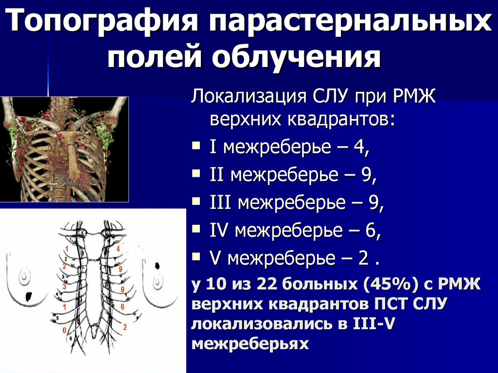 у 10 из 22 больных (45%) с РМЖ верхних квадрантов ПСТ СЛУ локализовались в III-V межреберьях
