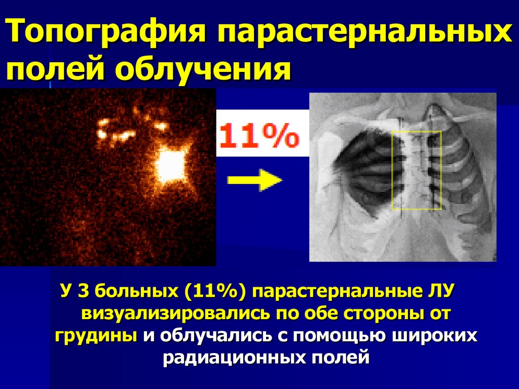 Топография парастернальных полей облучения