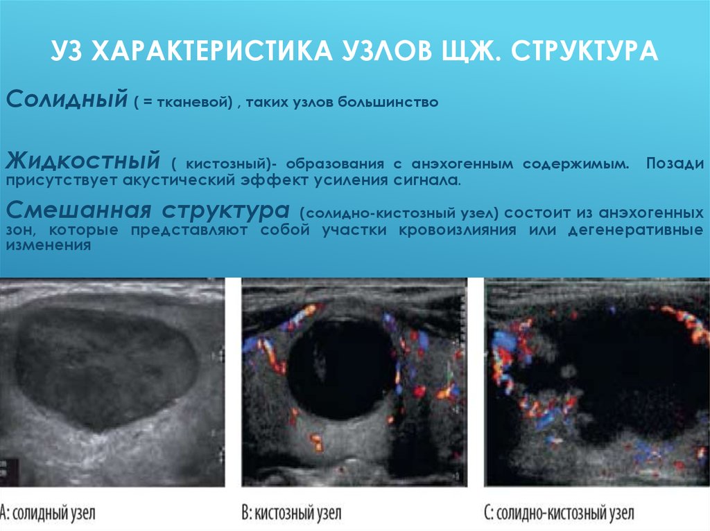 Образования щитовидной. Губчатый узел щитовидной железы на УЗИ. Солидное образование щитовидной железы. Солидное образование в щитовидной железе. Солидный узел в щитовидной железе.