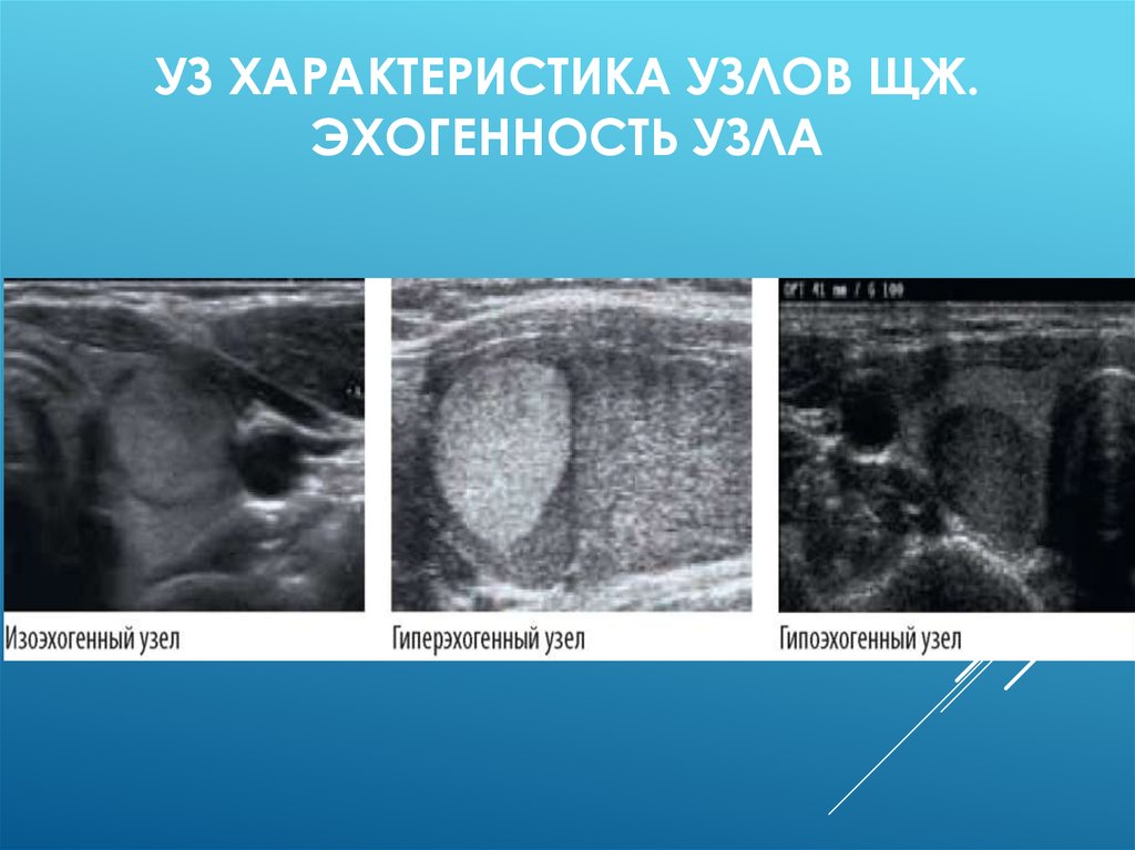 Узловое образование в доле щитовидной железы