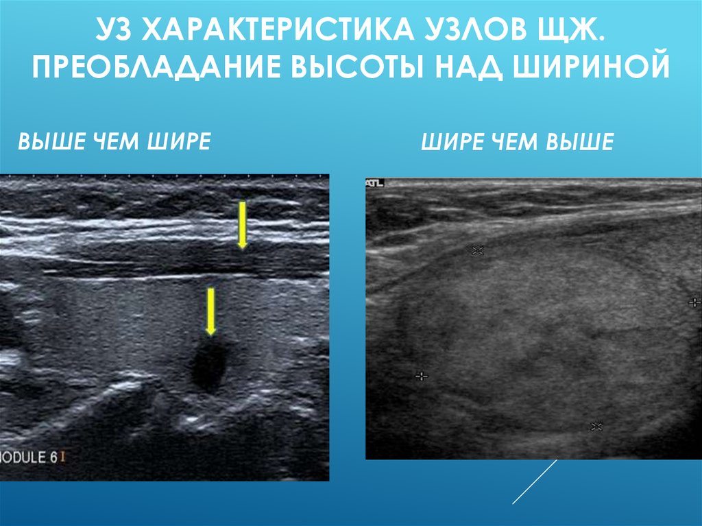 Узи узлов. Выше чем шире узел щитовидной железы. Вертикальная ориентация узла щитовидной железы. ЗНО щитовидной железы УЗИ. Узел выше чем шире.