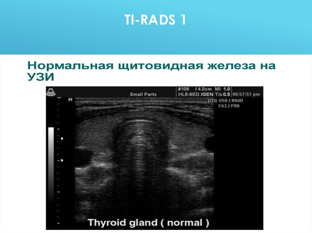 Ti rads 3 в щитовидной. Ультразвуковое исследование (УЗИ) щитовидной железы. Губчатый узел щитовидной железы на УЗИ. Фиброзирующий тиреоидит Риделя на УЗИ. Классификация тирадс щитовидной железы УЗИ.