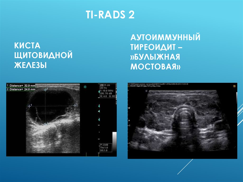Диагностика щитовидной железы презентация