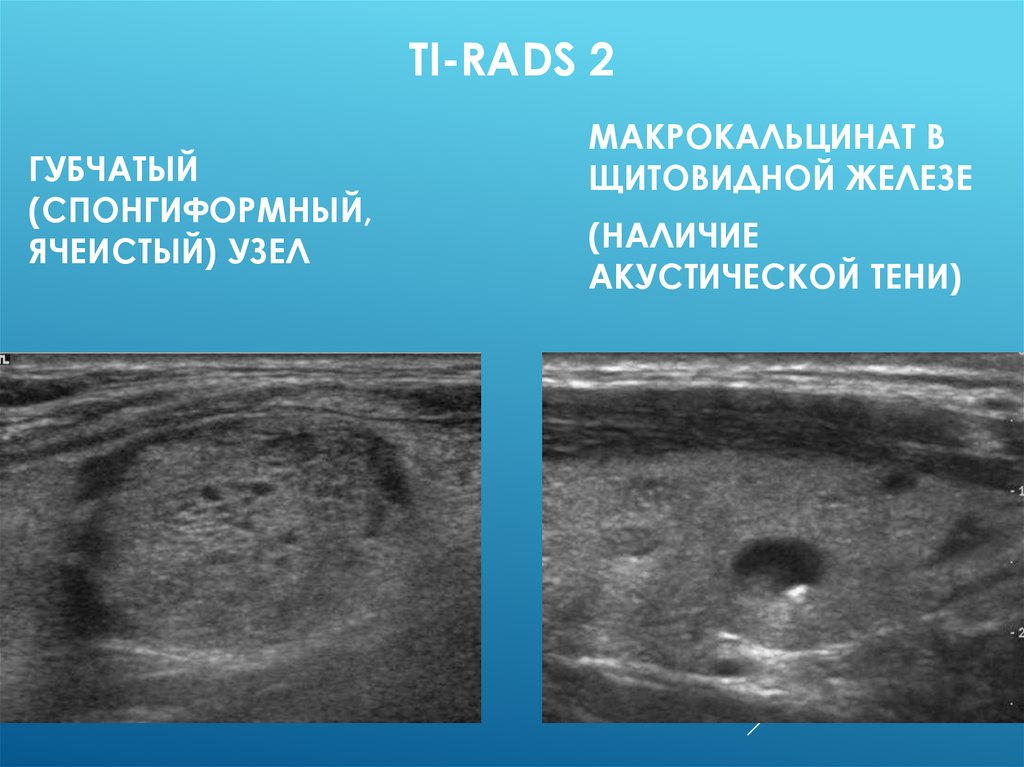 Tirads щитовидной железы