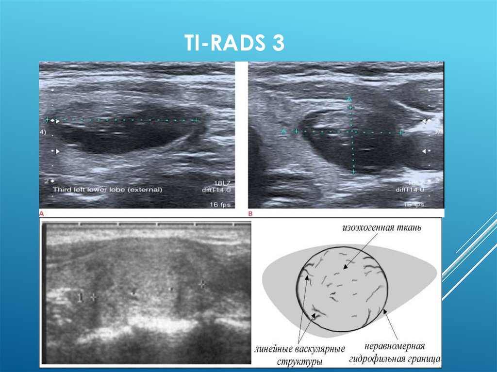 Ti rads 3 в щитовидной. Tirads классификация узлов щитовидной железы УЗИ. Щитовидная железа УЗИ ti-rads. РАДС классификация щитовидной железы на УЗИ. Тирадс 3 щитовидной железы на УЗИ.
