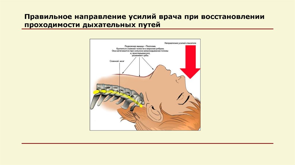 Восстановление дыхательных путей последовательность. Маневры открытия дыхательных путей. Правильно оценить проходимость дыхательных путей визуально. I-Gel предназначен для восстановления проходимости дыхательных путей:. Правильное направление.