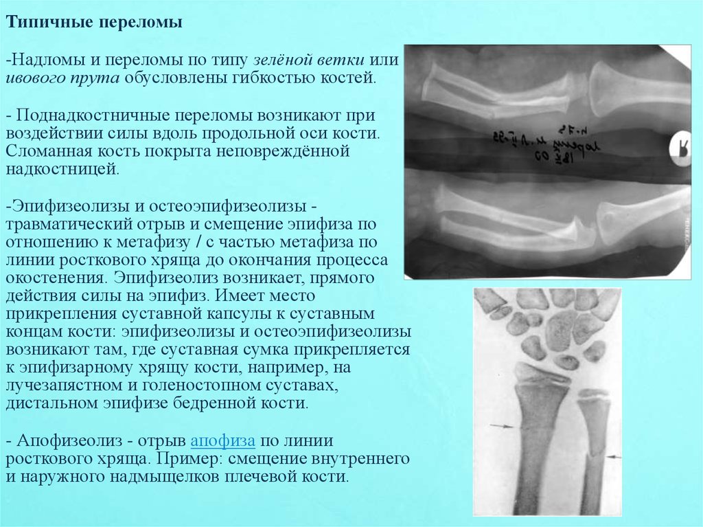 Дистальных метафизов лучевой