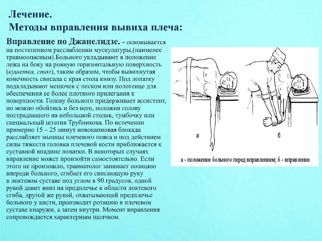 Как лечить плечевой. Вправление вывихов бедра Джанелидзе. Вправление вывиха плеча методом Джанелидзе. Метод Джанелидзе вправление. Вправление вывиха тазобедренного сустава по Джанелидзе.