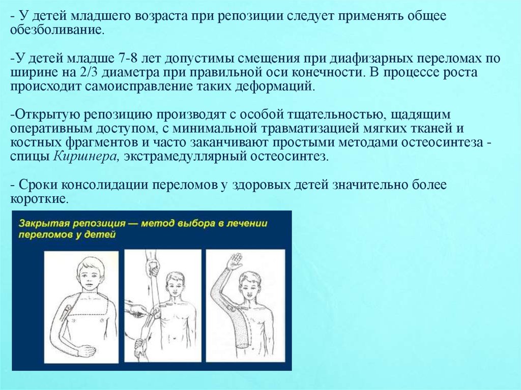 Применять общий. Обезболивание при переломах у детей. Допустимые смещения при переломах у детей по возрасту таблица. Лечение переломов в детском возрасте.