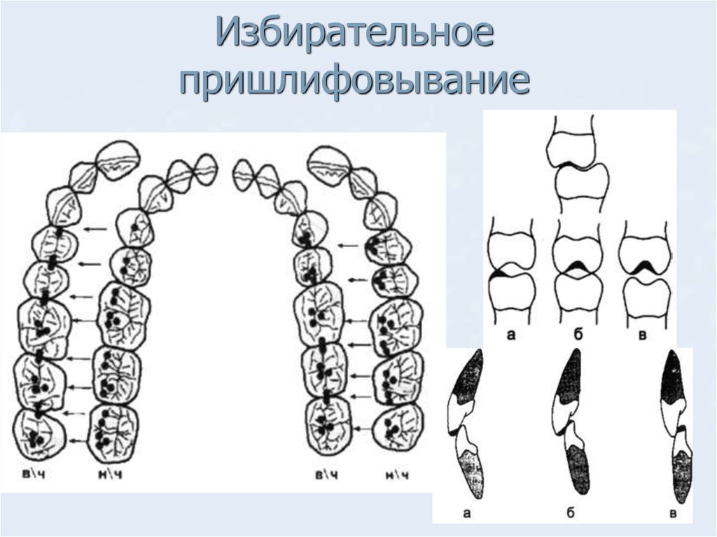 Схема окклюзионных контактов - 87 фото