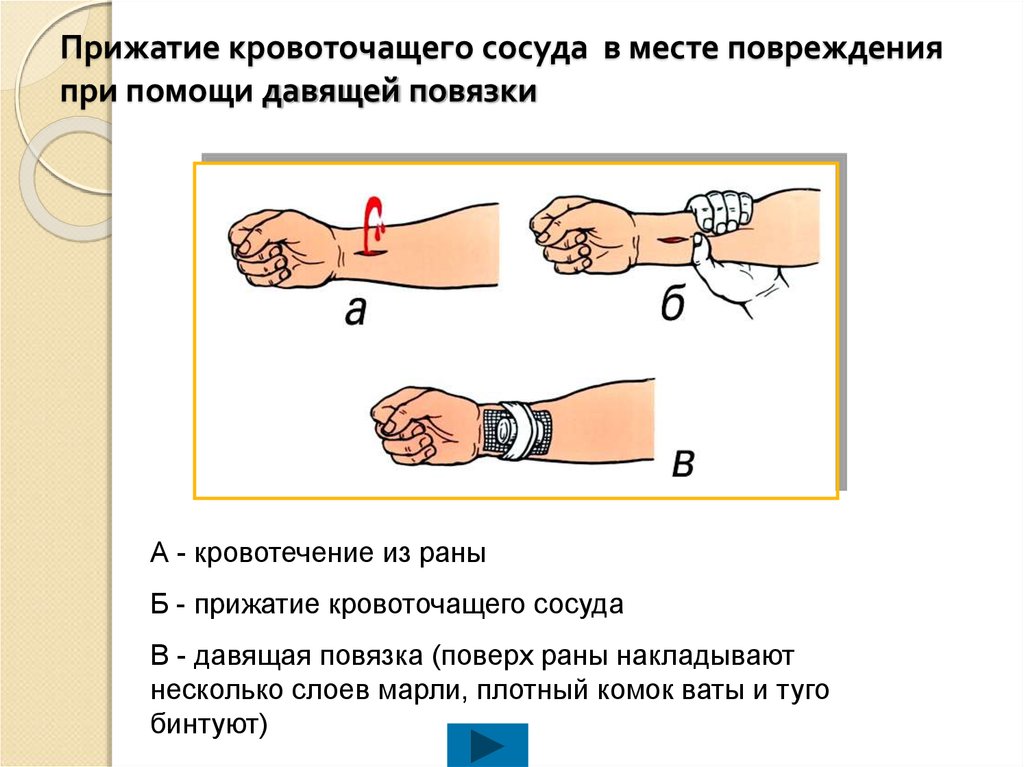 Наложение давящей повязки